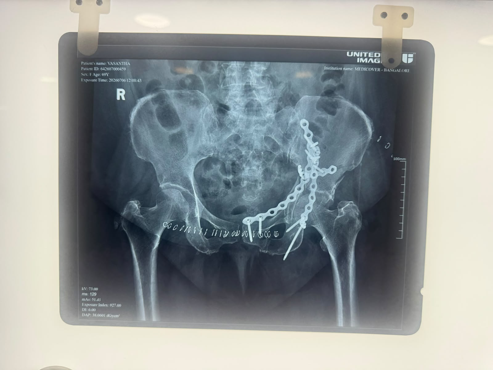 After hip fracture fixation X-ray with plate and screws